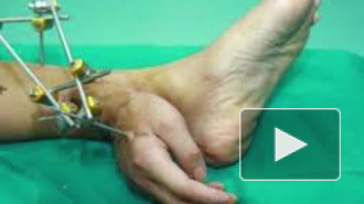 Китайские медики пришили руку пациента к ноге