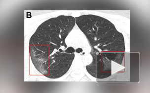 Китайские медики показали снимки легких, которые поражены коронавирусом