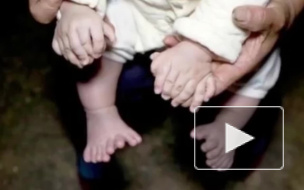 В Китае родился малыш с 31 пальцами